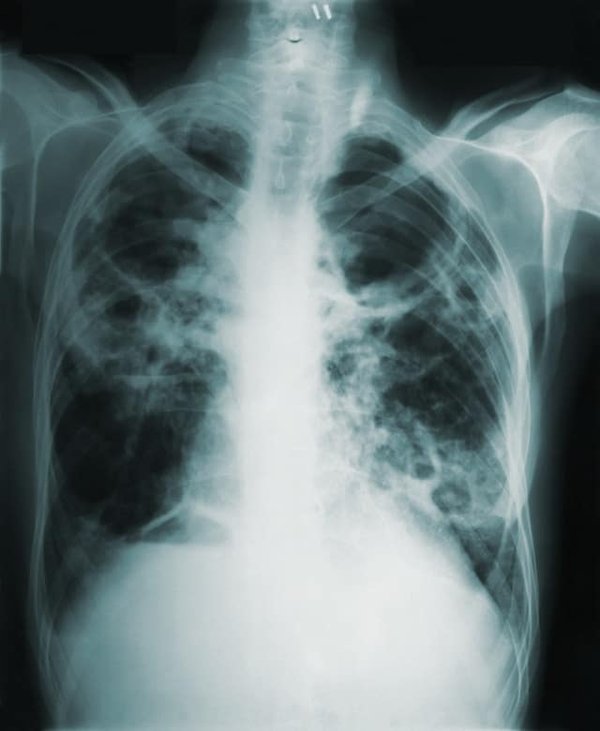 Embolie pulmonaire : Comprendre les signes, les facteurs de risque et les solutions efficaces