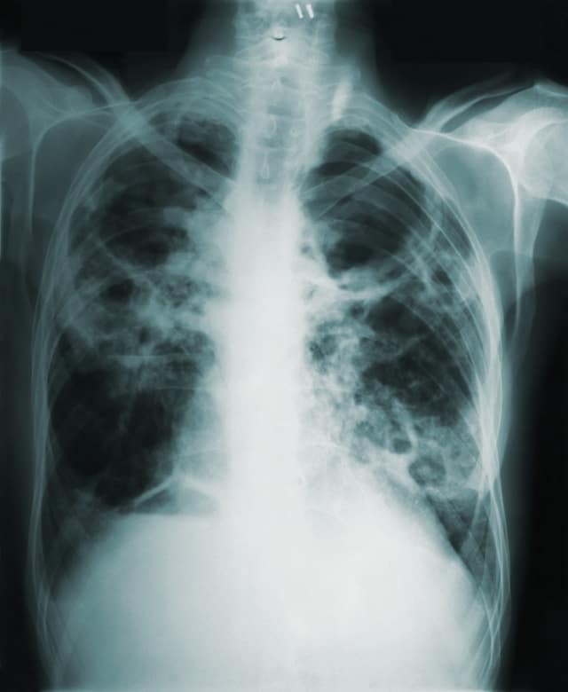 Embolie pulmonaire : Comprendre les signes, les facteurs de risque et les solutions efficaces